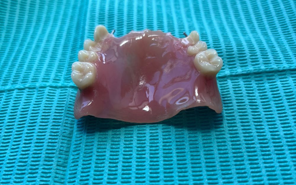 Prótesis terminada por nuestro laboratorio